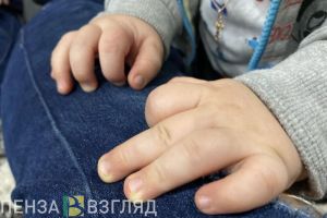 Пензенцам рассказали, о чем могут свидетельствовать высыпания на коже ребенка