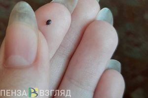 Пензенский врач назвала первые признаки заражения после укуса клеща